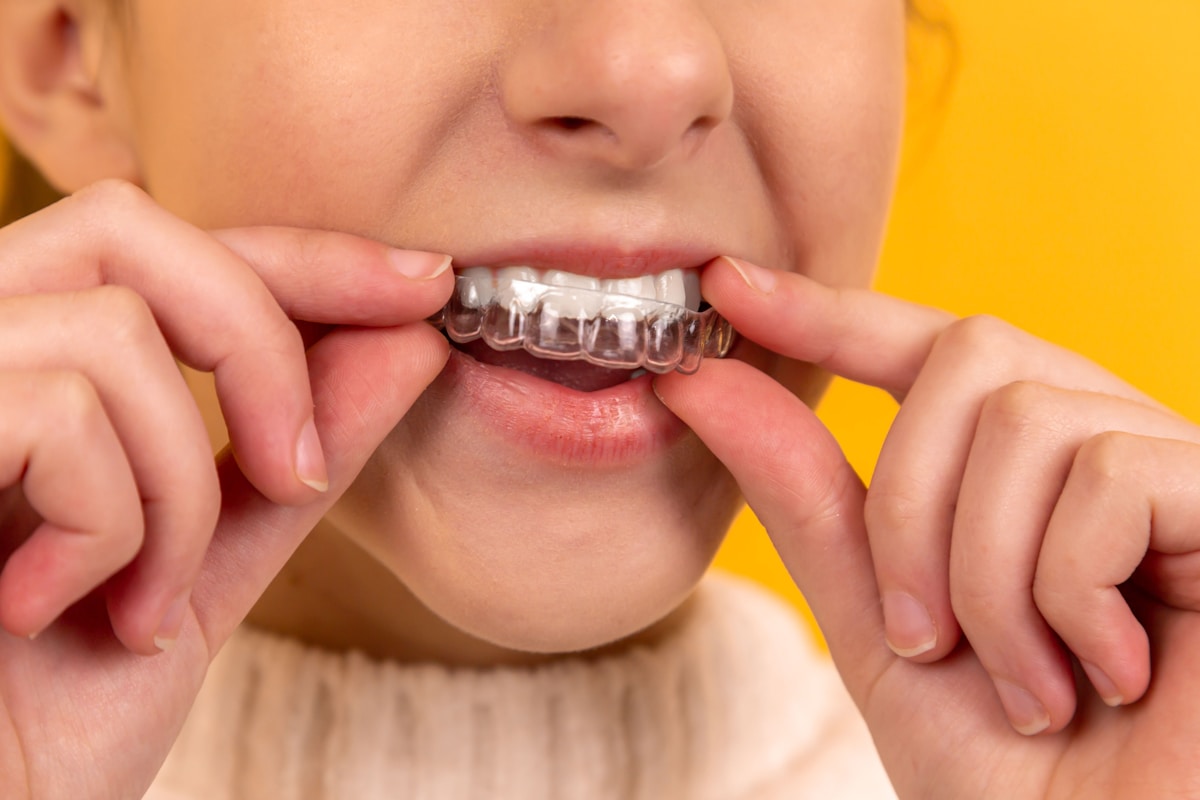 Caso Invisalign